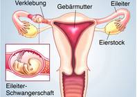 Eileiterschwangerschaft