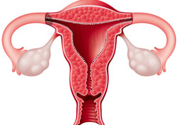 Endometriose