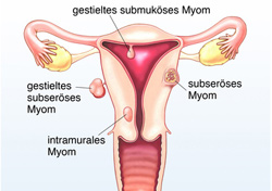 Myome